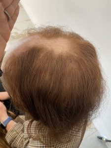 alopecia on the crown alopecia on the crown