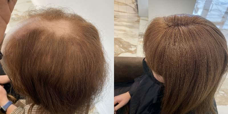 A Guide On The Best Hair Loss Treatment For Females