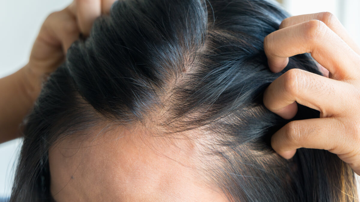 Postpartum hairline